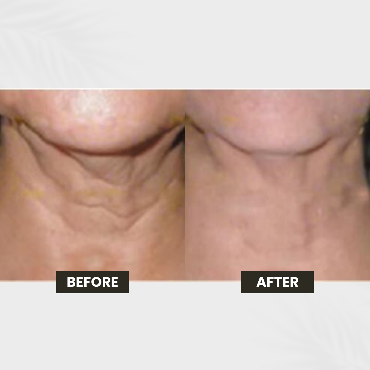Melasma transformation result