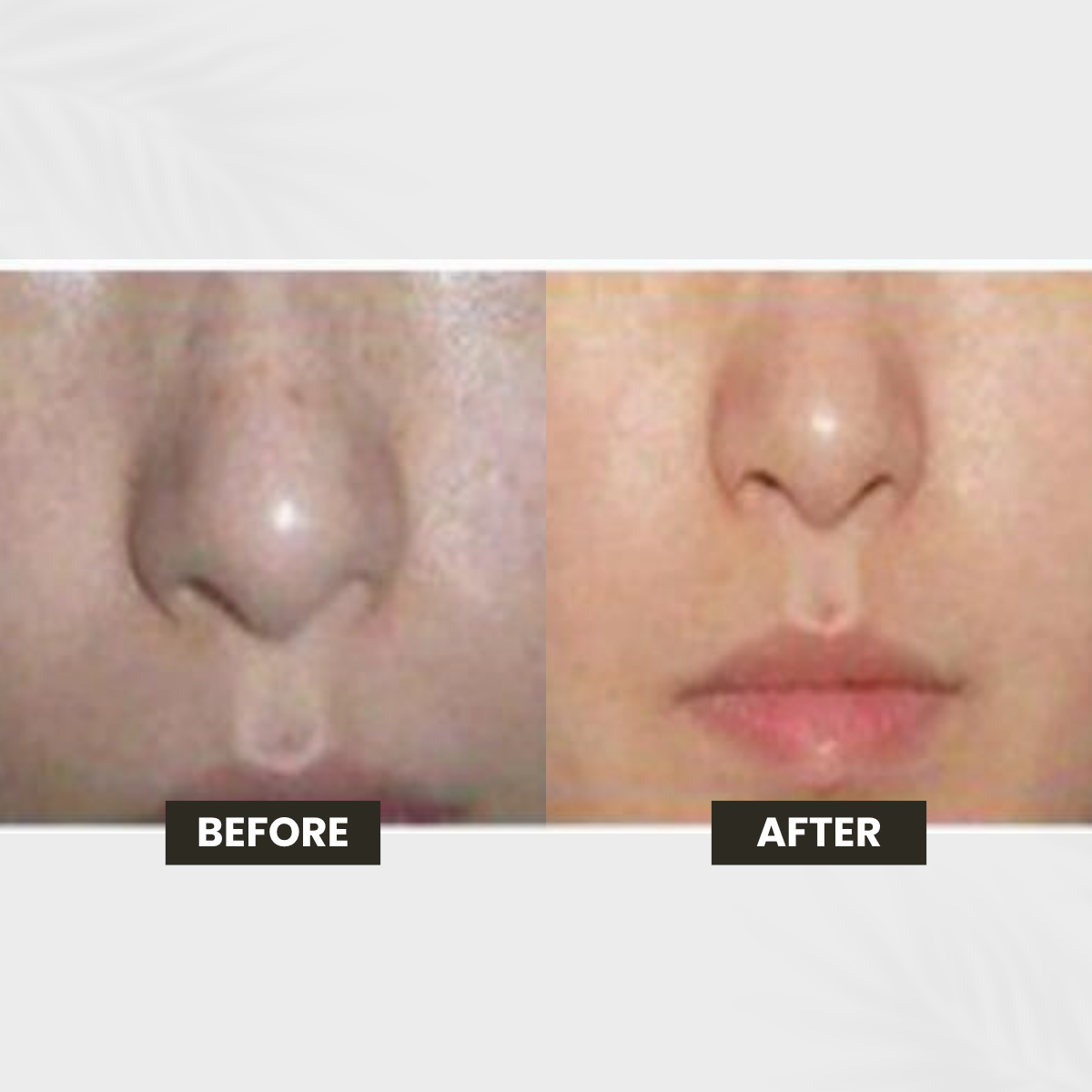 Pigmentation & Uneven Tone transformation result