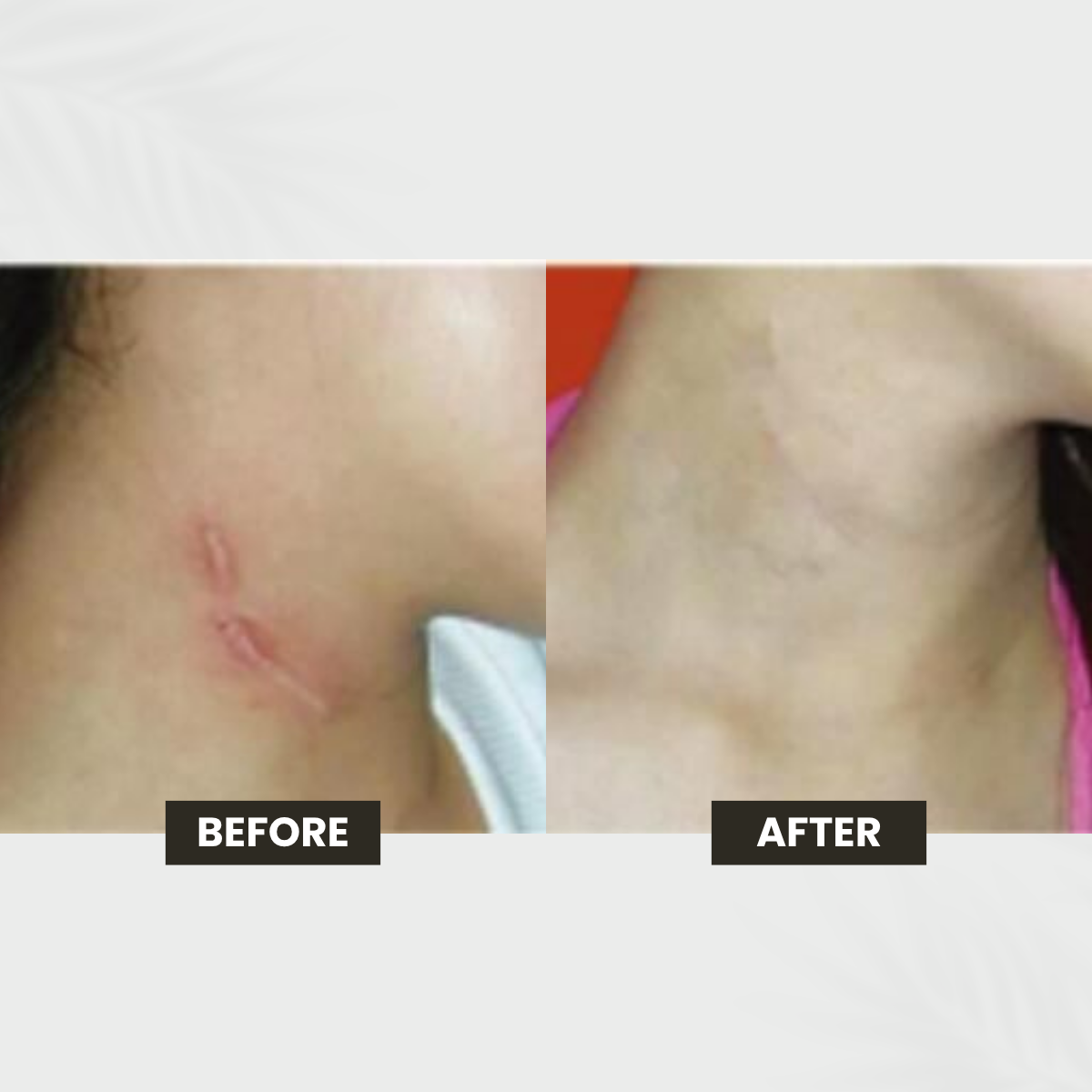 Rolling Scars transformation result