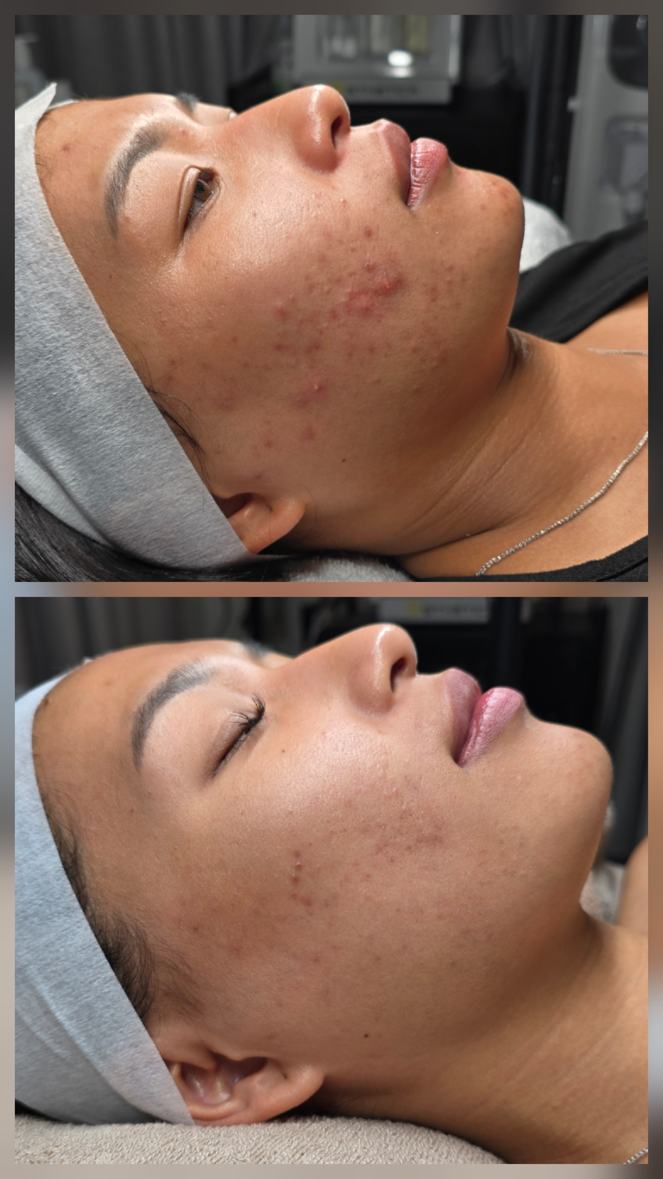 SQT Bio-Microneedling before and after results - acne treatment transformation