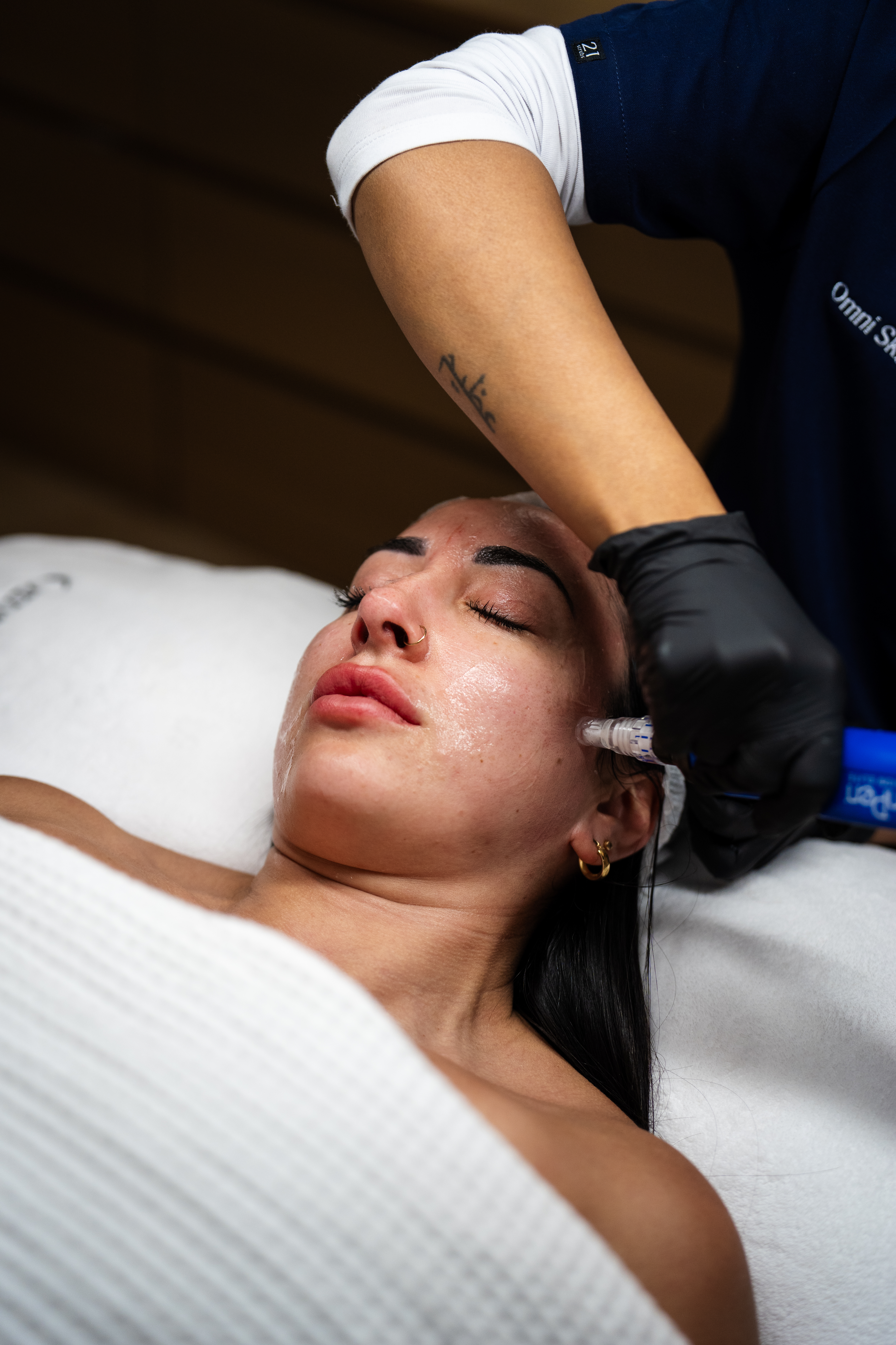 Microneedling