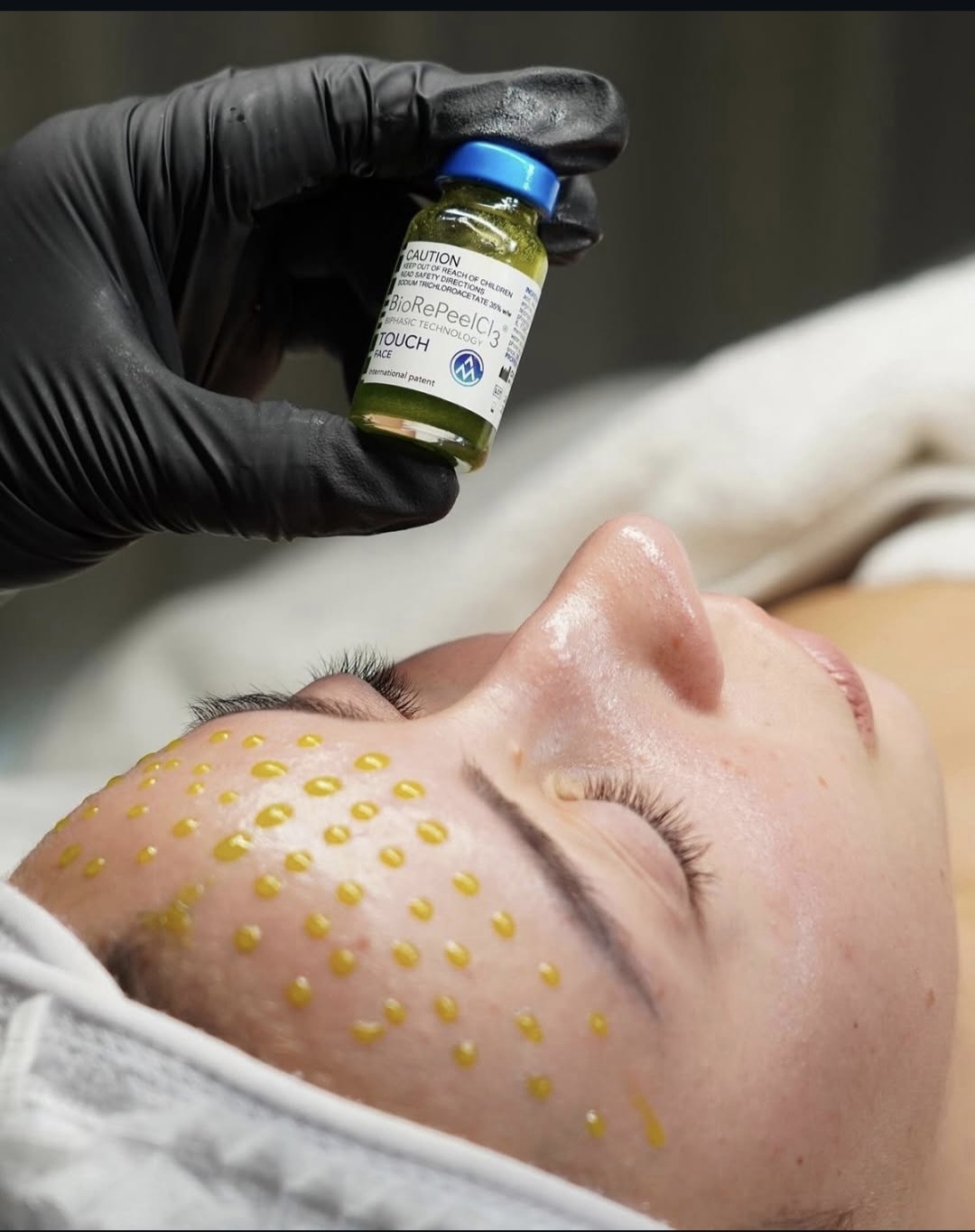 Chemical Peels